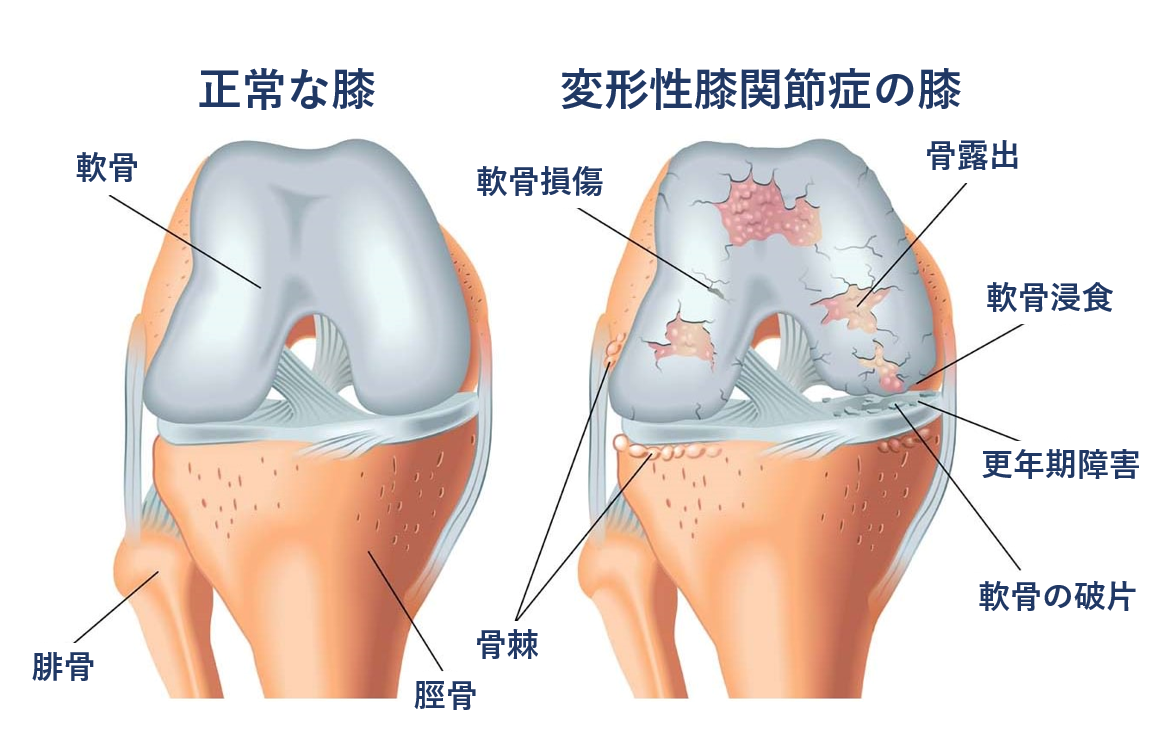 正常な膝と、変形性膝関節症の膝