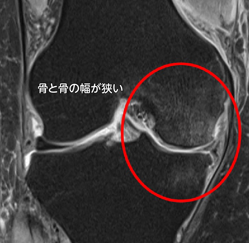 軽度の変形性膝関節症患者のMRI