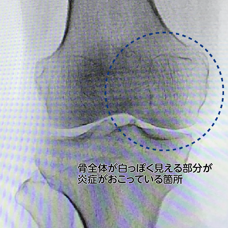 軽度の変形性膝関節症患者のレントゲン