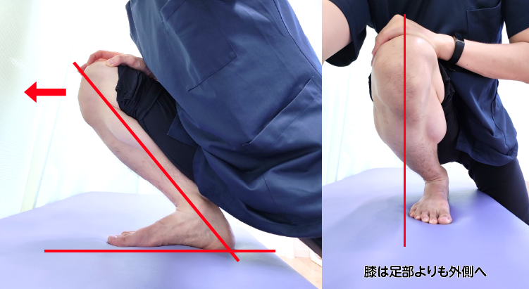 足関節背屈可動域制限の改善