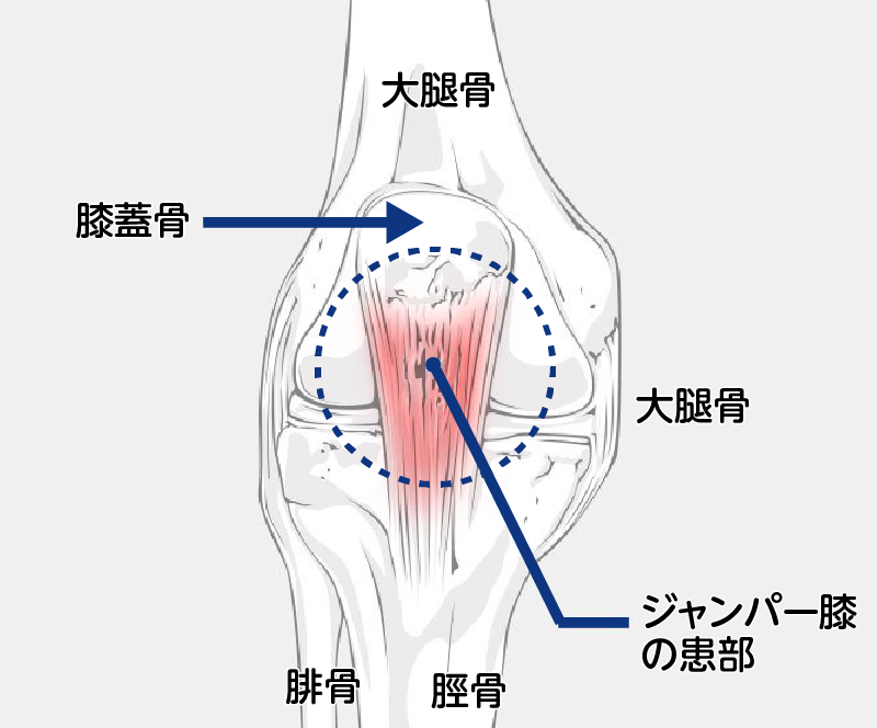 ジャンパー膝で痛くなる場所（正面から見た図）