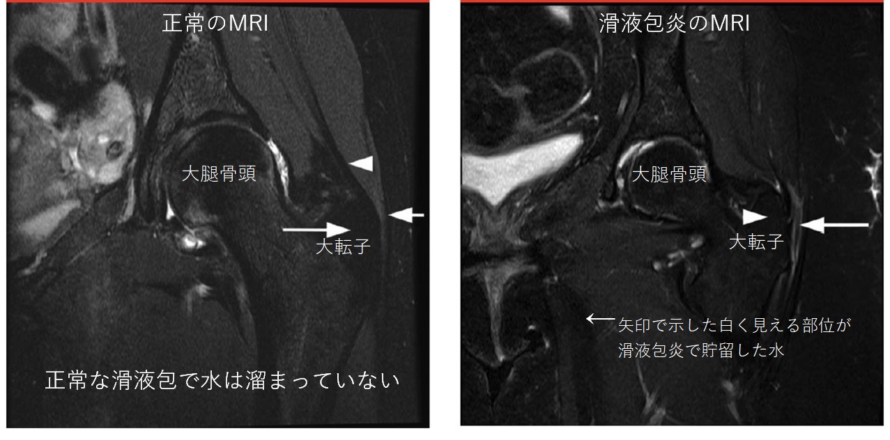 大転子滑液包炎のMRI
