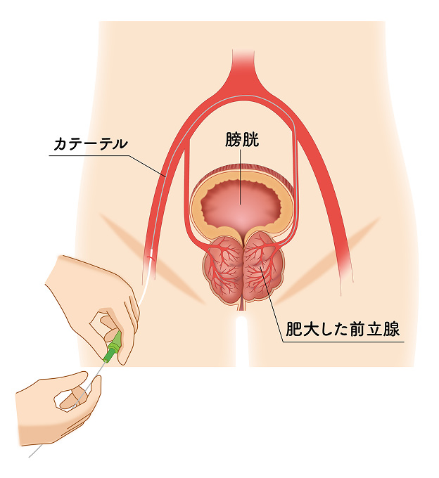 前立腺肥大のカテーテル治療のイメージ画像