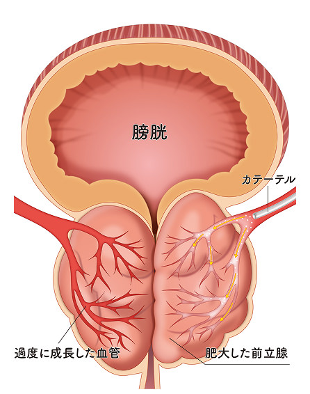 肥大した前立腺のイメージ画像①