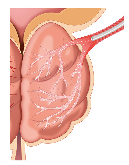 肥大した前立腺のイメージ画像②