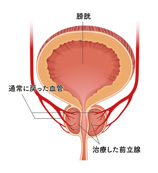 治療した前立腺のイメージ画像