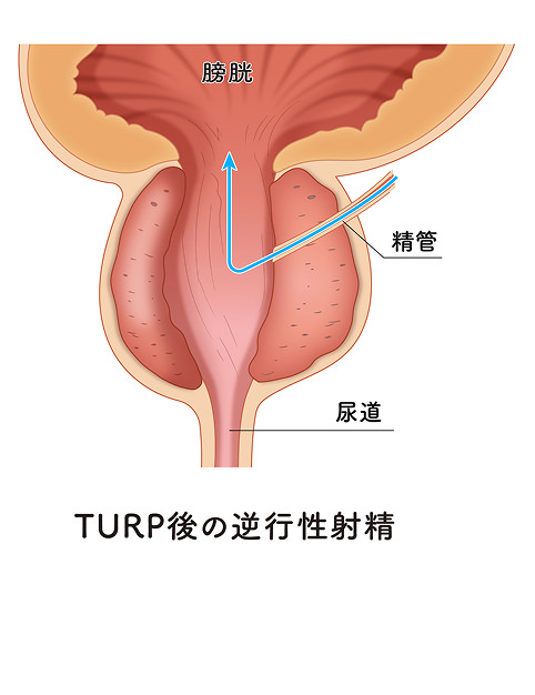 TURP後の逆行性射精のイメージ画像