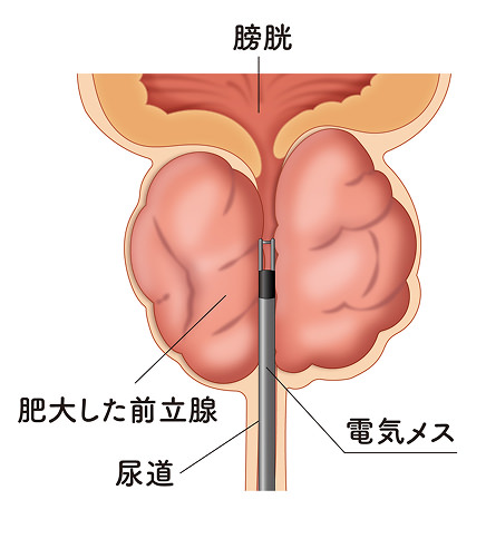 TURPの治療図のイメージ画像①