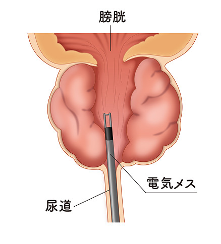 TURPの治療図のイメージ画像②