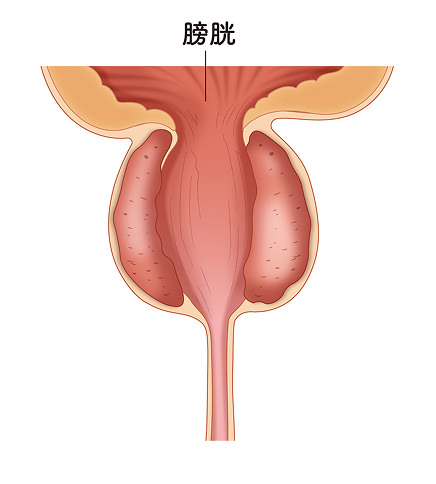 TURPの治療図のイメージ画像③