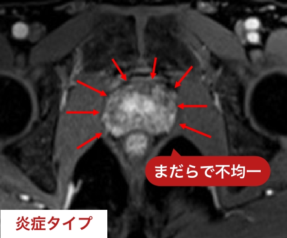 炎症タイプのMRI画像