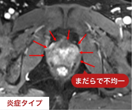 炎症タイプのMRI画像