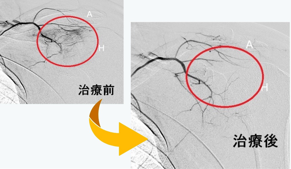 モヤモヤ血管の治療前と治療後のレントゲン写真