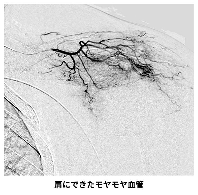 モヤモヤ血管とは