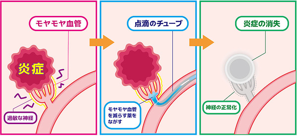 博多駅前院のモヤモヤ血管治療方法