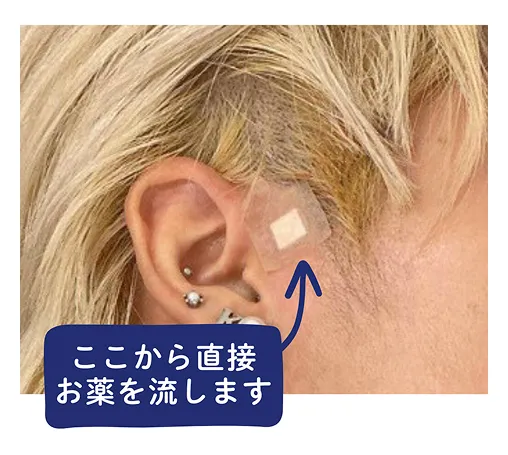 浅側頭動脈に向けた動注治療のイメージ画像