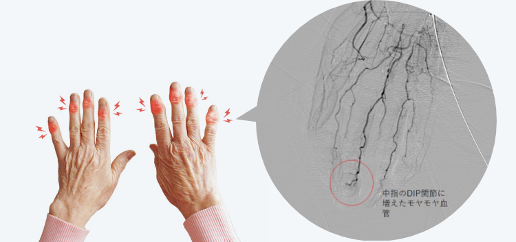 中指のDIP関節に増えたモヤモヤ血管