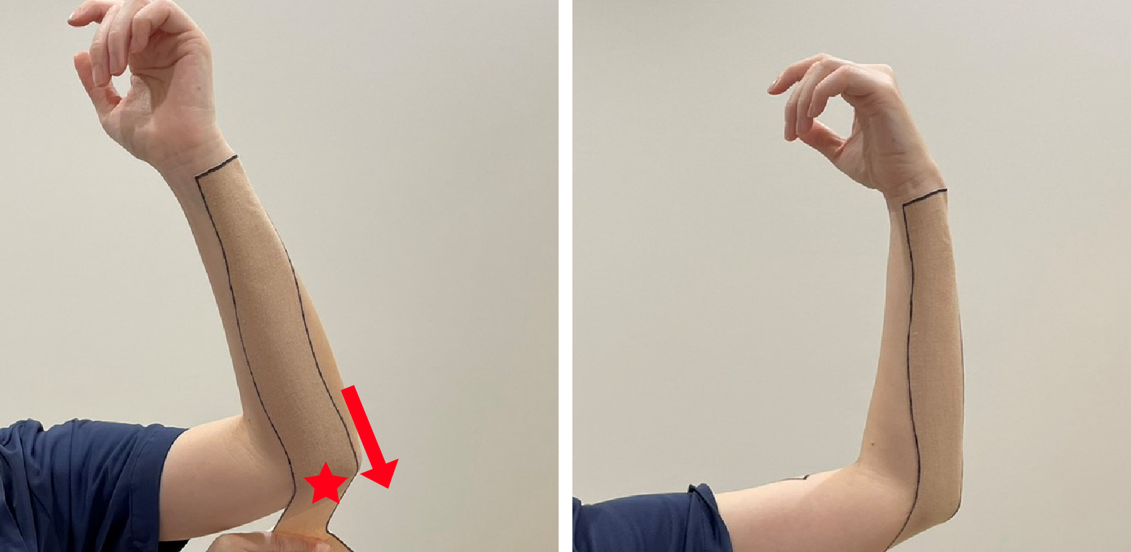 痛みのある部分（★）だけ少しテープを引っ張りながら肘の後ろ側に向かって貼ります。肘から上腕の部分はテープを引っ張らずに貼ります。