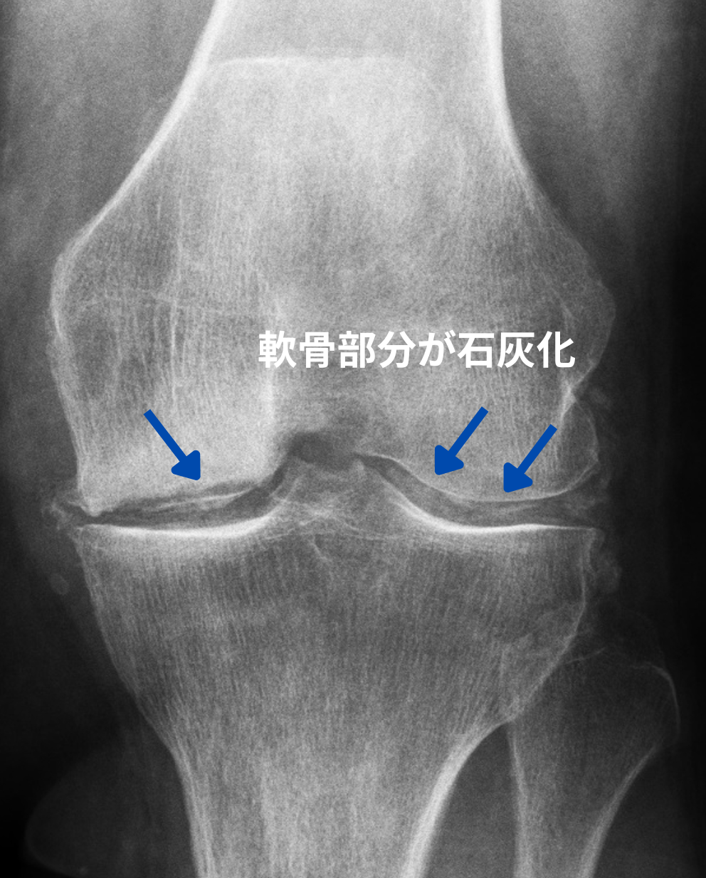 偽痛風の診断