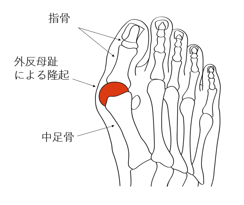外反母趾の疼痛部位