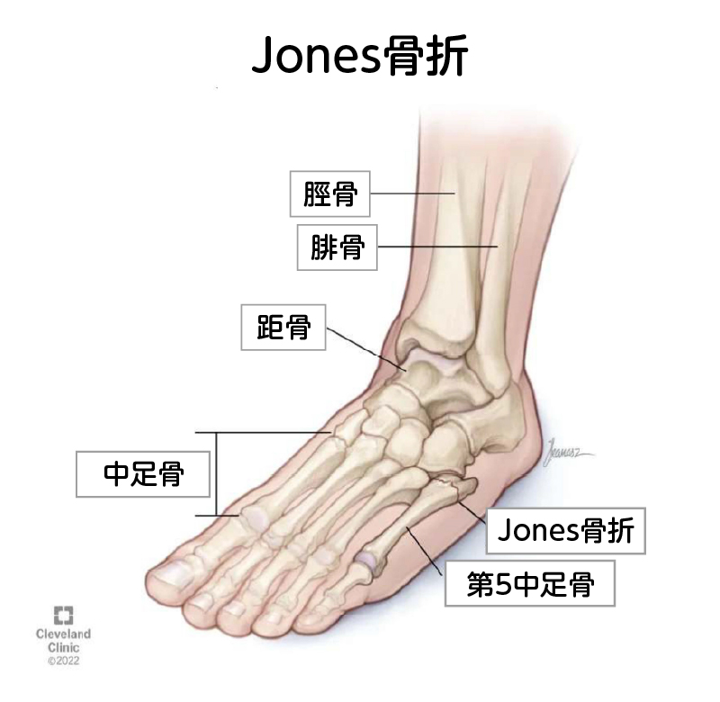Jones骨折