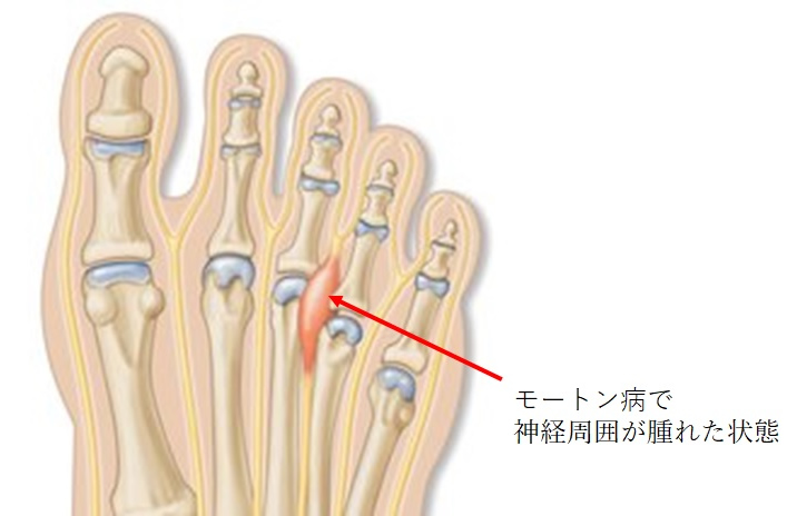 モートン病 慢性痛治療の専門医による痛みと身体のq A