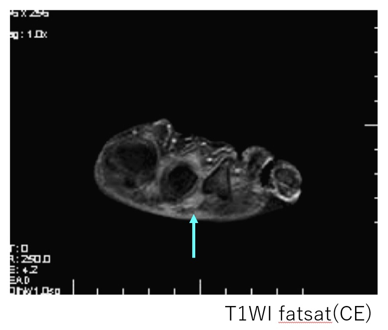 モートン病のMRI　矢印の部位が造影されたモートン神経腫