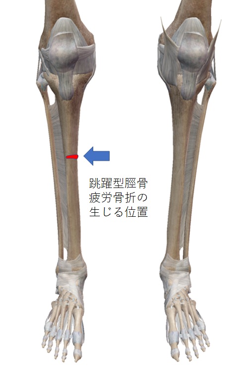 左足内側の外脛骨部