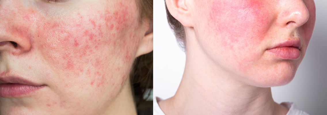 酒さ（しゅさ）