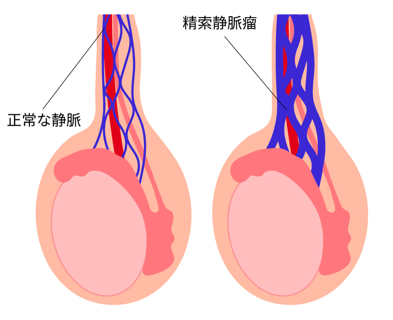 正常な静脈と精索静脈瘤
