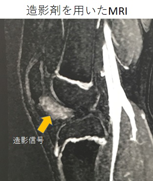 原因不明とされた膝蓋下脂肪体炎の症例 オクノクリニック