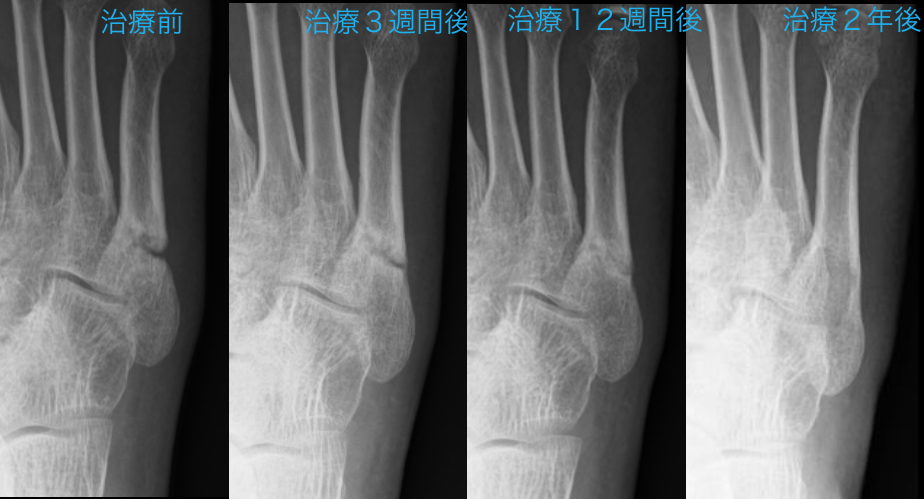 足の骨折の原因は何ですか？