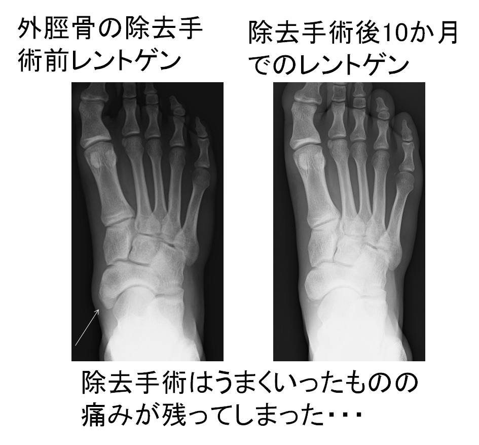 手術しても改善しなかった有痛性外脛骨の高校生への治療実例 オクノクリニック