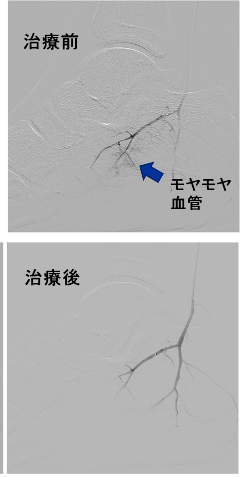 手術しても改善しなかった有痛性外脛骨の高校生への治療実例 | オクノクリニック