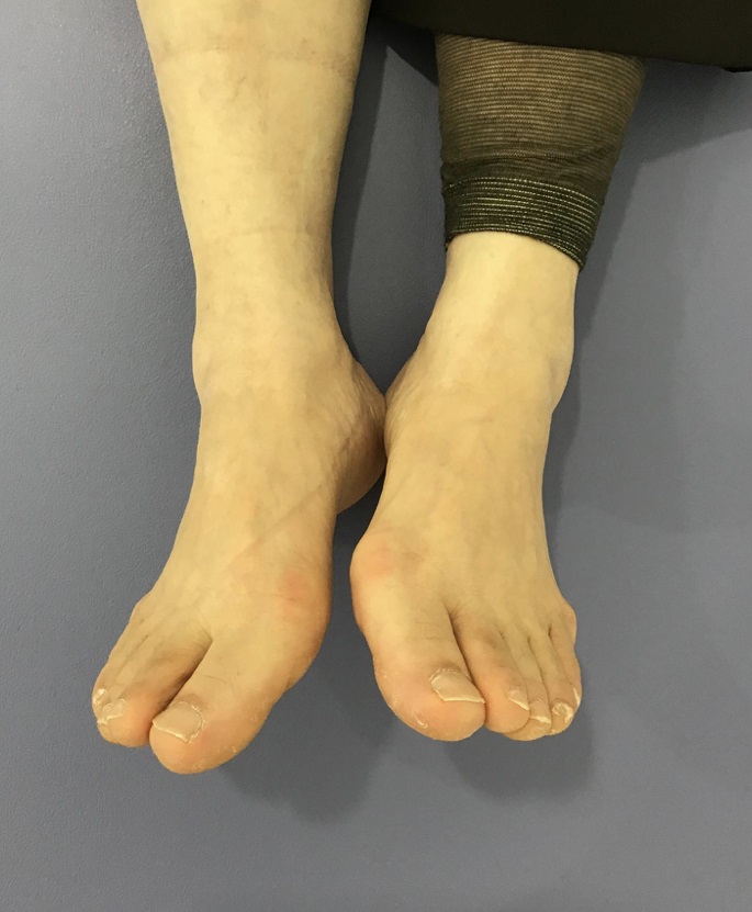 両足の外反母趾の痛み 5分でできる動注治療 オクノクリニック