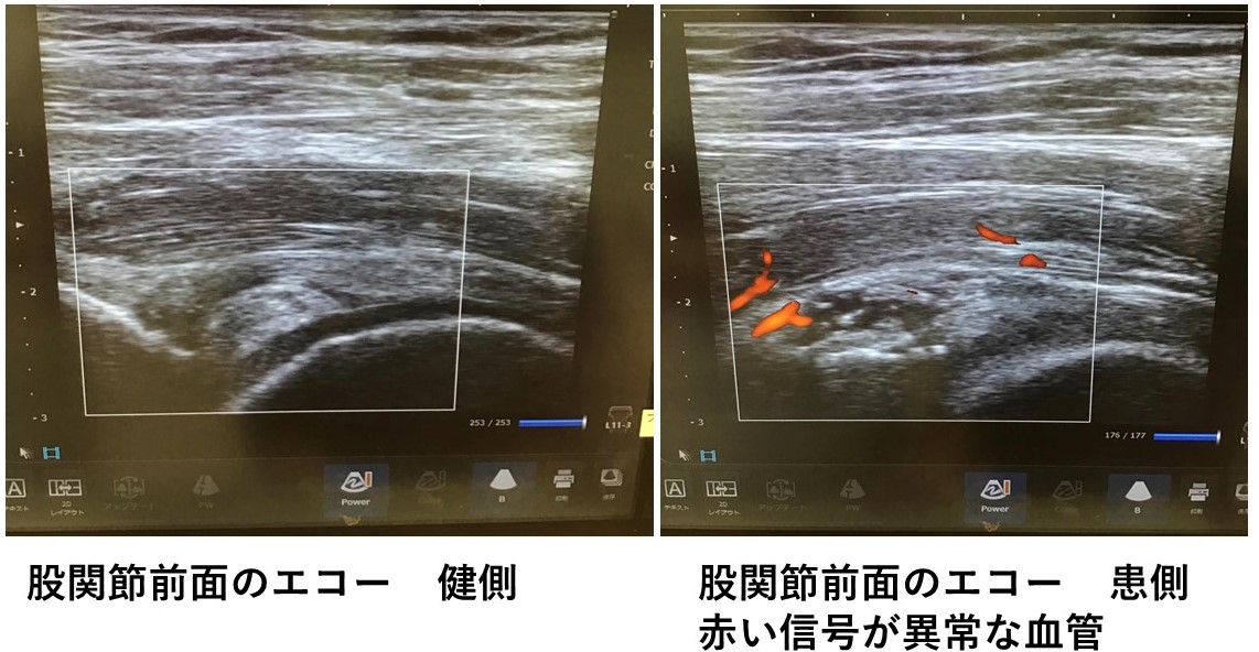 股関節唇損傷の痛みへのカテーテル治療の実例 オクノクリニック