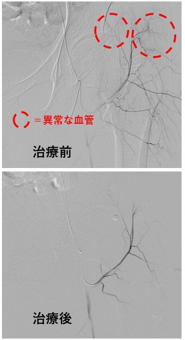 股関節唇損傷の痛みへのカテーテル治療の実例 オクノクリニック