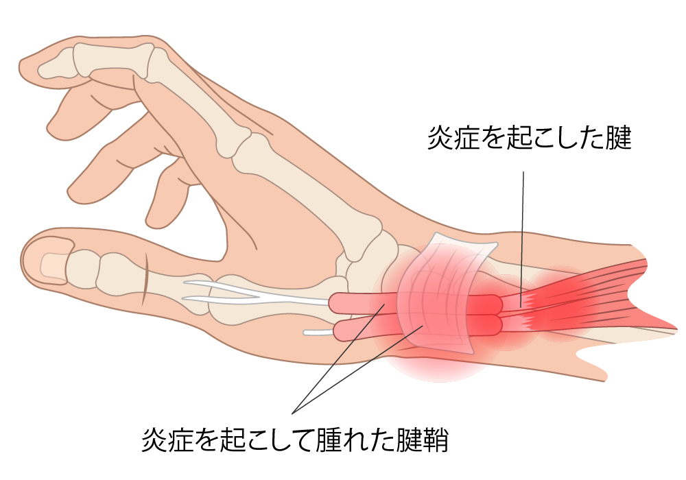 ドケルバン病（母指の腱鞘炎の一種）