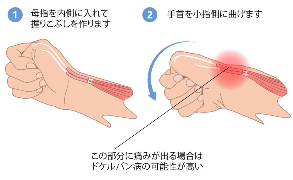 フィンケルシュタインテスト