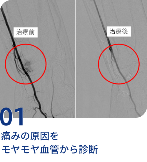 痛みの原因をモヤモヤ血管から診断