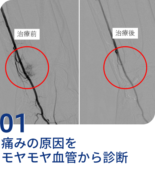 痛みの原因をモヤモヤ血管から診断