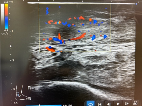 超音波検査によるアキレス腱の炎症の診断