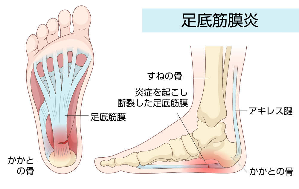 足底筋膜炎