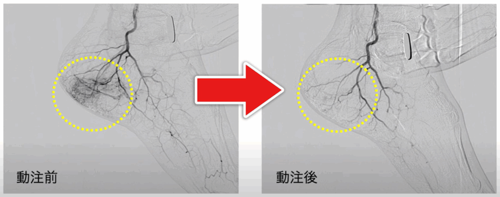 足底腱膜炎のモヤモヤ血管