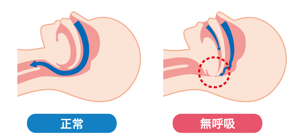 睡眠時無呼吸症候群
