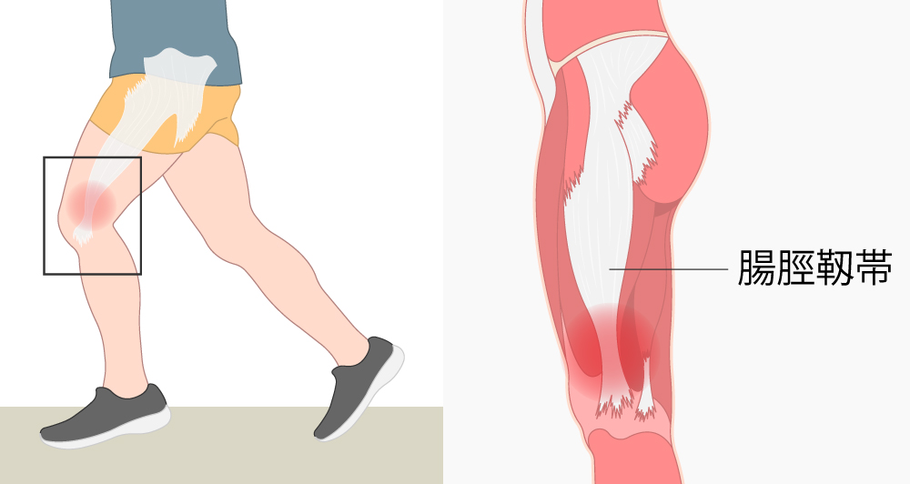 腸脛靱帯炎(ランナー膝)