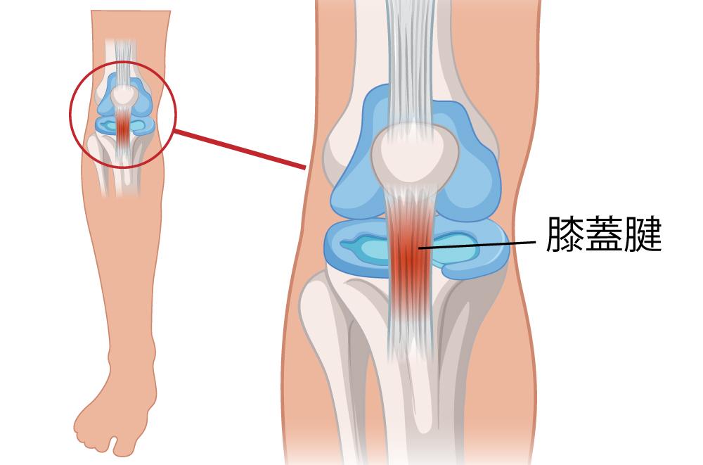 膝蓋腱炎(ジャンパー膝)