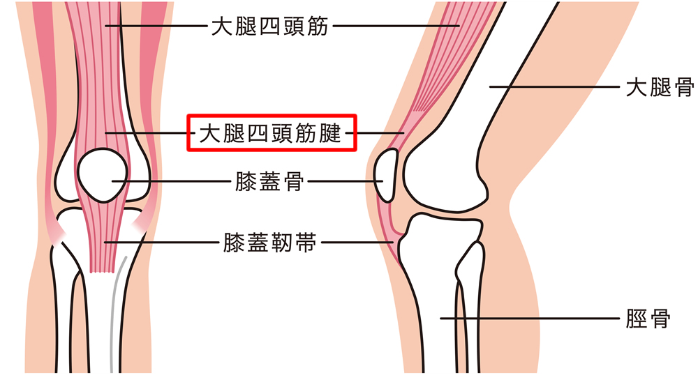大腿四頭筋腱