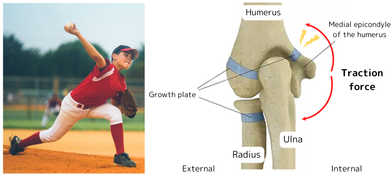 When you're throwing, there's another force that's working against your elbow.