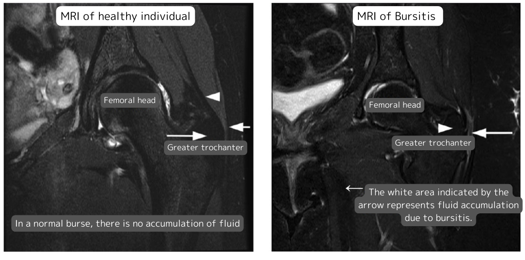 MRI